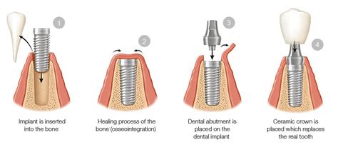 Straumann Dental Implants - Downtown Toronto Dentist