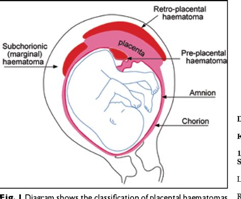 Figure 1 from Massive pre-placental and subchorionic haematoma. | Semantic Scholar