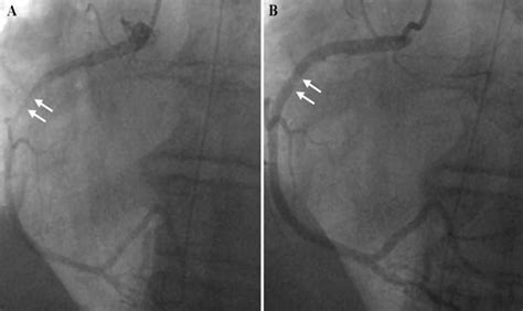 Coronary Vasospasm; Coronary Artery Vasospasm