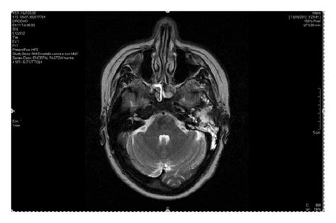 MRI revealing left mastoid cells and the middle ear occupied by a soft... | Download Scientific ...