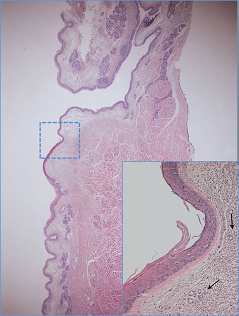 Histopathological Characteristics of Sulcus Vocalis - Sunter - 2011 ...