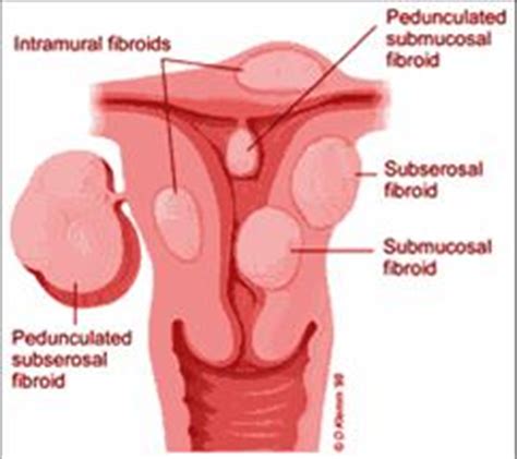 What are Fibroids? - Dr Paul Crowe