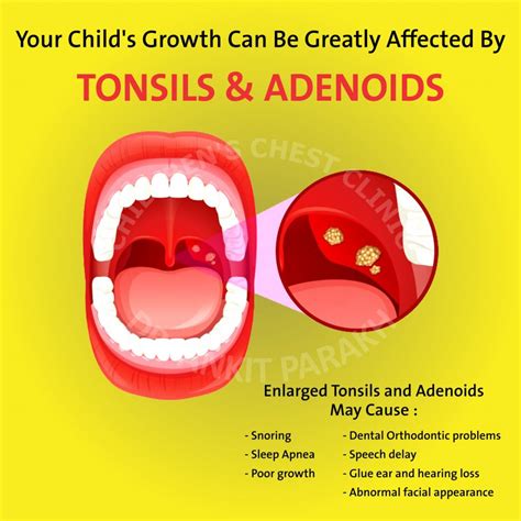 Enlarged Tonsils and Adenoids in Children: diagnosis & treatment - Dr ...