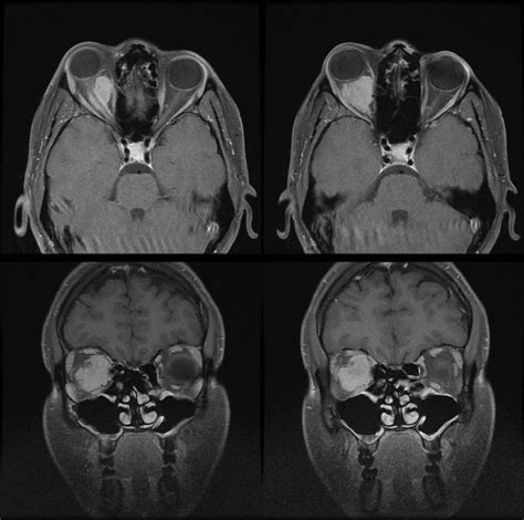 A large exophytic globular optic nerve sheath meningioma demonstrated... | Download Scientific ...