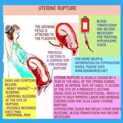 Dear Nurses: UTERINE RUPTURE