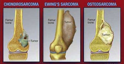 Types-of-Bone-Cancer