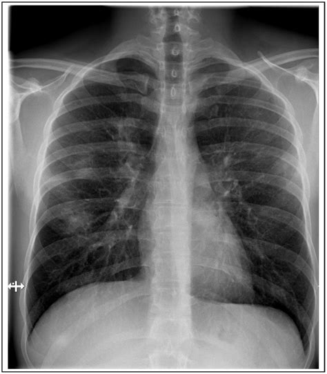 Chest X Ray Infiltrates