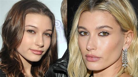 Hailey Bieber's Plastic Surgery: Has the Model Gotten Lip Fillers, a ...