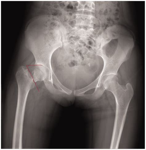 Femur Fracture X Ray