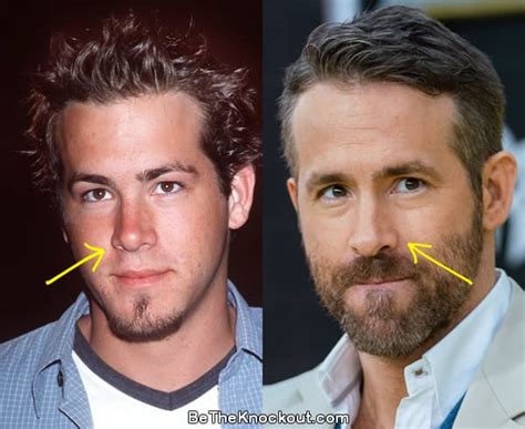 Ryan Reynolds Plastic Surgery Comparison Photos