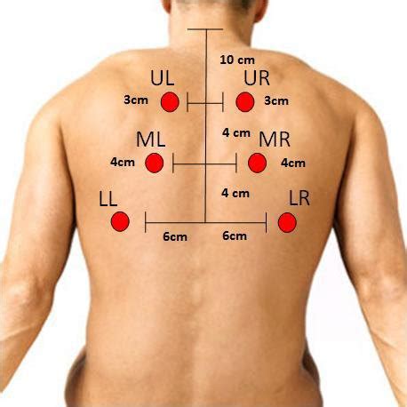 Six posterior chest location for auscultation Figure 1. Six posterior... | Download Scientific ...