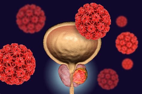 Radiation therapy for prostate cancer - Tests to predict tolerance to ...