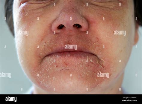 Woman suffering with eczema & a rash covering most of the face with ...