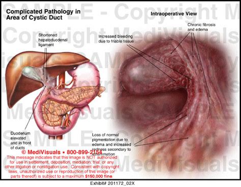 Complicated Pathology in Area of Cystic Duct Medical Exhibit