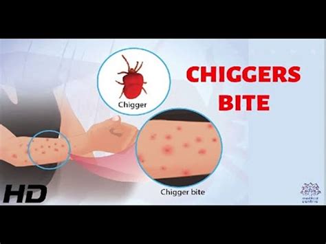 Chiggers Vs Ticks