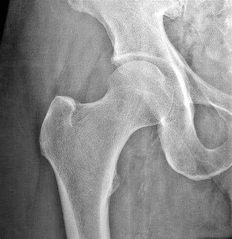 synovial herniation pit | pacs