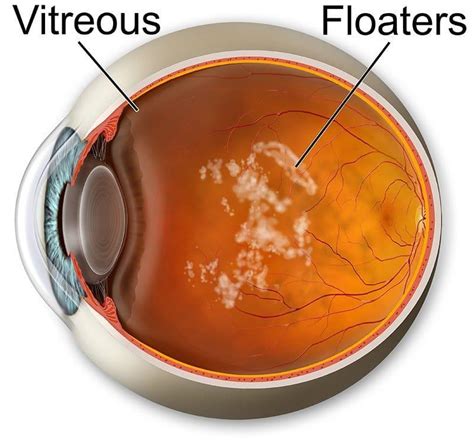 Summary of Retinal Diseases - South Pasadena, CA: Retina Eye Specialists