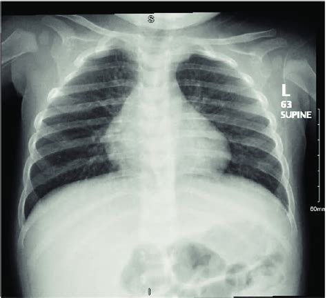 Chest radiograph showing normal cardiomediastinal silhouette and clear ...