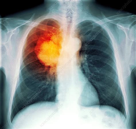 Chest Xray For Diagnosis Of Lung Cancer