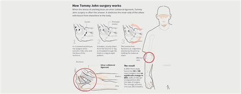 TOMMY JOHN SURGERY (UCL INJURY) - MOTUS Physical Therapy