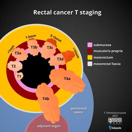 Rectal cancer (staging) | Radiology Reference Article | Radiopaedia.org