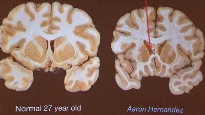 Aaron Hernandez's brain was severely damaged by disease, researcher ...