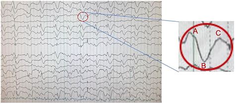 Electroencephalography (EEG) revealed 3 to 4 Hz triphasic waves with a... | Download Scientific ...