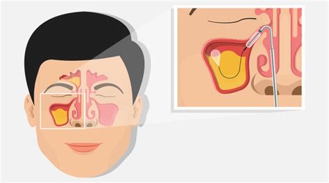 Balloon Sinus Surgery Kirkland | NW Face Medical