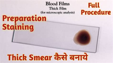 Thick smear | Peripheral blood smear - YouTube