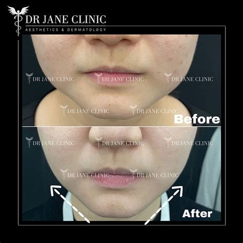 Face V Shaping: Achieve a Youthful and Sculpted Facial Profile | Dr ...