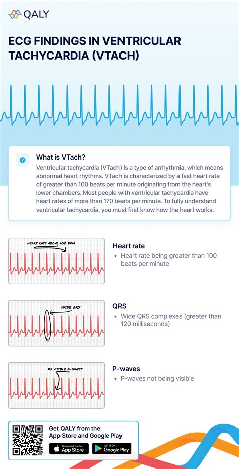 Ventricular Tachycardia Ecg