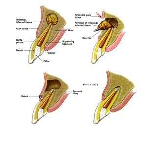 Apicoectomy procedure explained | News | Dentagama