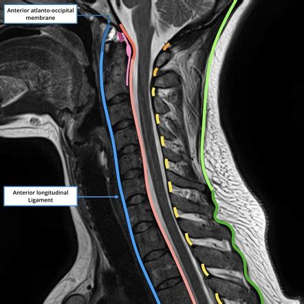 Anterior longitudinal ligament | Radiology Reference Article ...