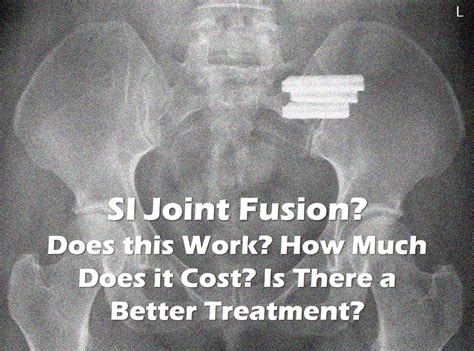 SI Joint Fusion: Does This Work? | Regenexx Blog