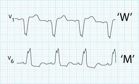 Left Bundle Branch Block (LBBB) • LITFL • ECG Library Diagnosis