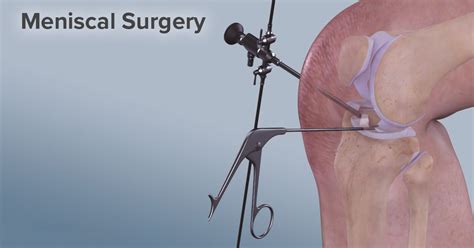 Meniscus Tear in Bangalore | Meniscal Surgery in Bangalore