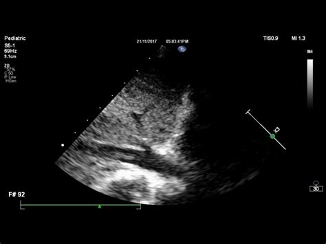 Fontan palliation for single ventricle – SujyotHeartClinic