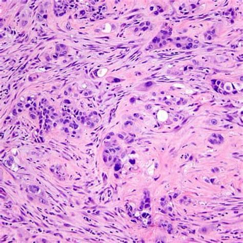 Malignant pleural mesothelioma, biphasic type. | Download Scientific ...