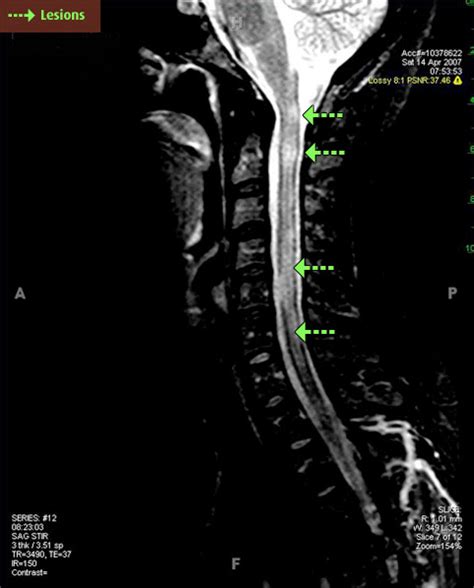 Understanding Your MRI | MS Living Well