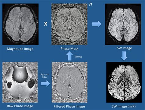 SWI, susceptibiltiy - Questions and Answers in MRI