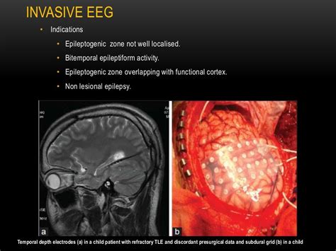 Mesial temporal lobe epilepsy