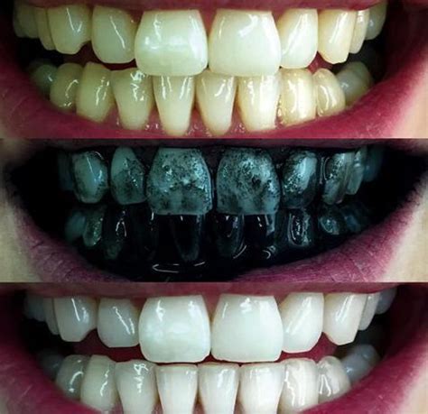 7 Secrets to Whiten your teeth with charcoal Fast - Biotyful.net