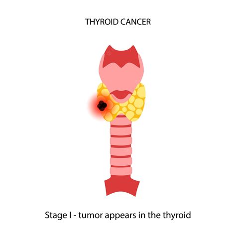 Premium Vector | Thyroid cancer stages