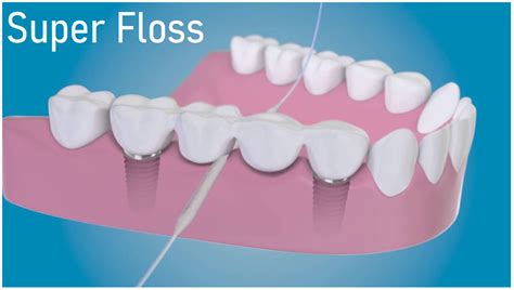 What is the difference between Superfloss, floss threaders, floss picks and dental floss ...