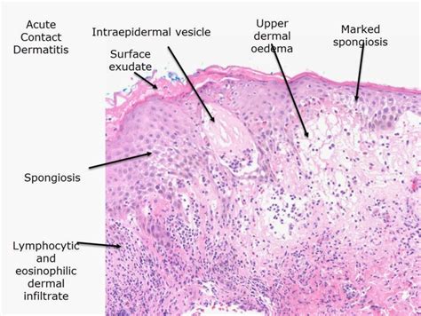 Spongiotic Dermatitis: Symptoms, Treatment & Prevention