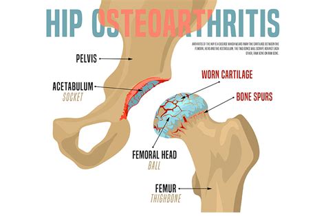 Osteoarthritis Hip Pain