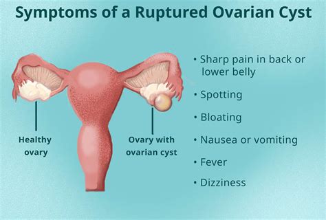 Ovarian Cyst Rupture: Pain Symptoms From Burst Cyst, 41% OFF
