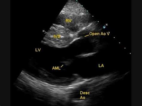 Color Doppler echocardiogram in hypertophic obstructive cardiomyopathy (HOCM) - YouTube