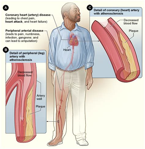 What is Peripheral Arterial Disease?