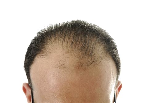 Why is My Hair Thinning? Signs of Balding in Your 20’s & 30’s – Toppik.com